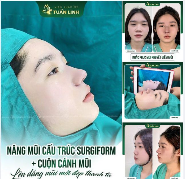 ''Lột xác'' hoàn toàn sau 90 phút nâng mũi cấu trúc Surgiform + cuộn cánh mũi!!