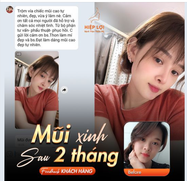 Feedback chiếc mũi xinh của khách yêu sau 2 THÁNG