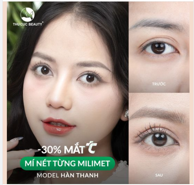 Khắc phục tình trạng đa nếp mí sau 15P Chọn Mắt TC