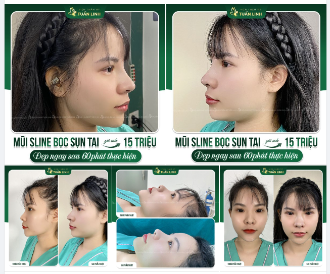 Chỉ với 15TRIỆU - Cùng gói trả góp 0% LÃI  60 Phút khắc phục dáng mũi thấp tẹt, sở hữu ngay: