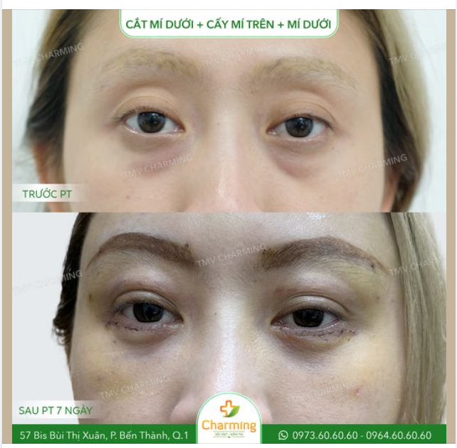 Đôi mắt của nàng khách trông rất lờ đờ do phần hốc mắt sâu, mí mắt không rõ, làm nàng trông già dặn hơn so với tuổi.