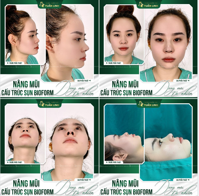 Cải thiện dáng mũi thấp tẹt với Nâng mũi cấu trúc Bioform!!