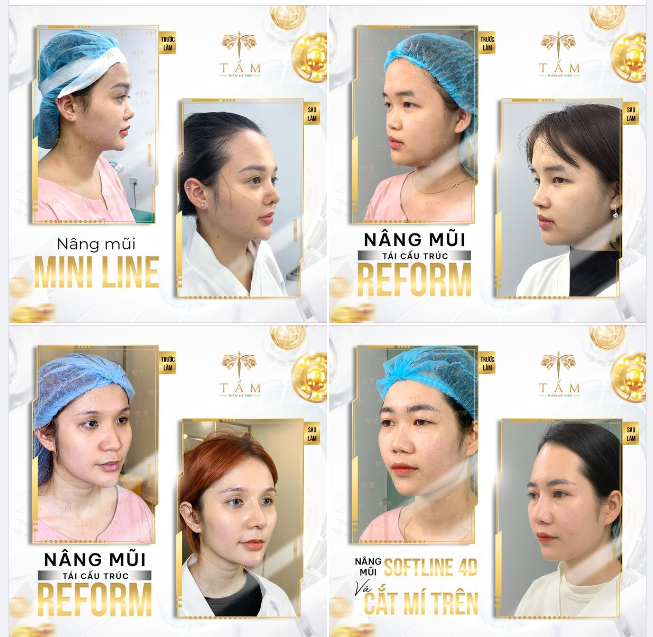 Sự khác biệt giữa trước  sau khi nâng mũi này đã cho chị em thêm động lực đến Tấm nâng mũi ngay và luôn chưa?