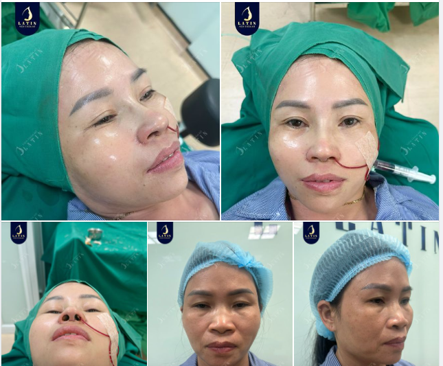 Mũi cấu trúc vừa hoàn thành cho chị khách đến từ Bình Phước