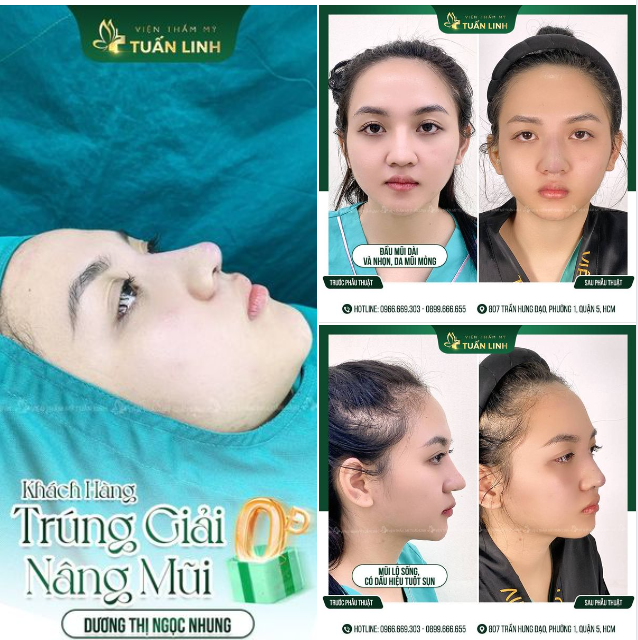 Khách hàng Dương Thị Ngọc Nhung - Trúng giải NÂNG MŨI 0 ĐỒNG!!