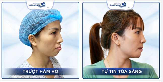 Chỉnh hàm hô Tự tin tỏa sáng