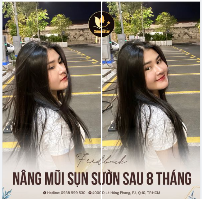 FEEDBACK NÂNG MŨI CẤU TRÚC SỤN SƯỜN SAU 8 THÁNG