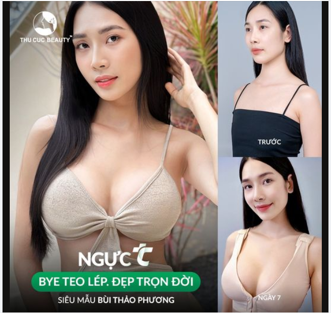 Nâng ngực đẹp, an toàn, quyến rũ