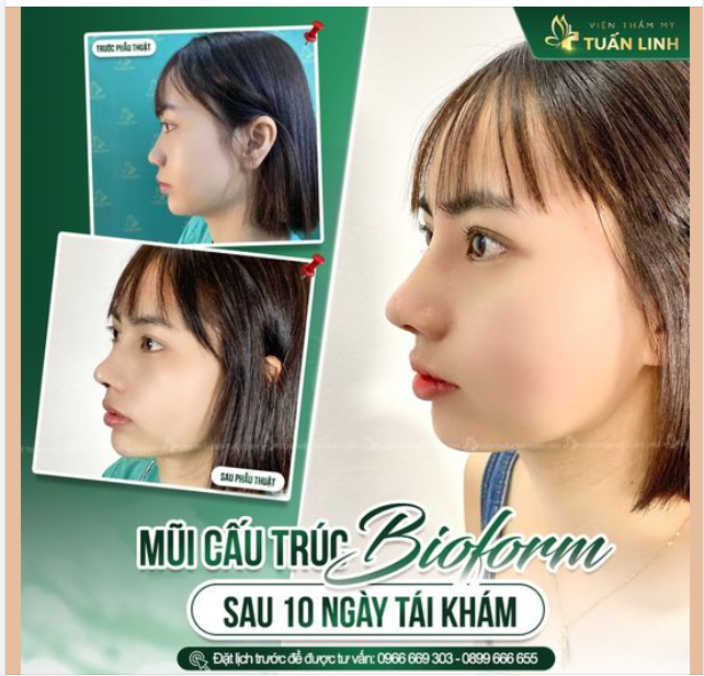 Mũi cấu trúc sụn Bioform sau 10 ngày tái khám!!