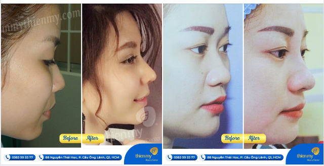 Dưới đây là những hình ảnh trước và sau khi nâng mũi tại PKCK Thiện Mỹ của các khách hàng thân yêu.