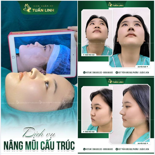 MŨI ĐẸP TỰ NHIÊN NHƯNG KHÔNG TỰ NHIÊN MÀ ĐẸP