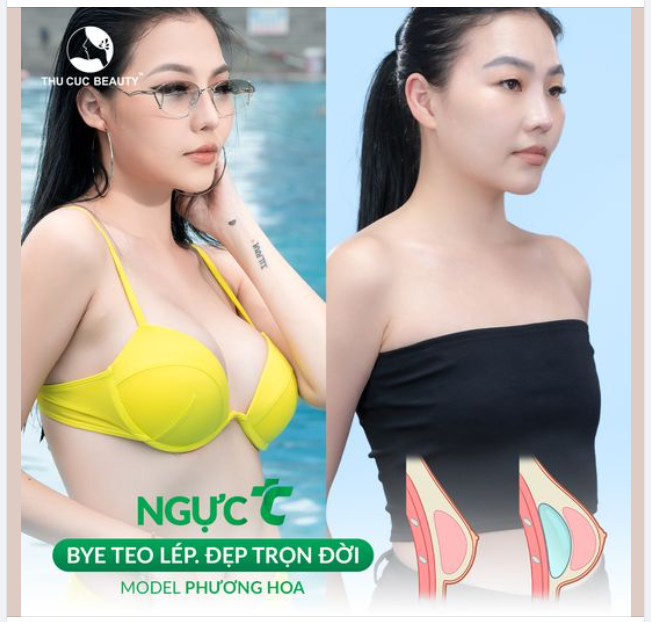 Nâng ngực đẹp tại TM Thu Cúc