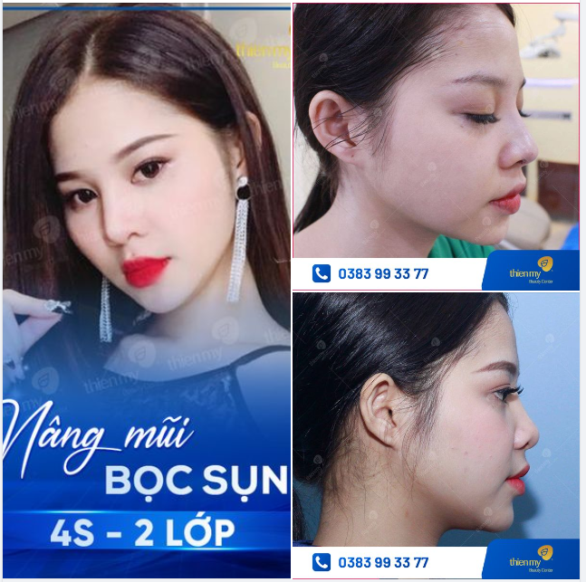 Dáng mũi tự nhiên nhẹ nhàng, thanh thoát, hài hòa. Vẻ đẹp hiện đại này liệu có phải là điều bạn kiếm tìm ??