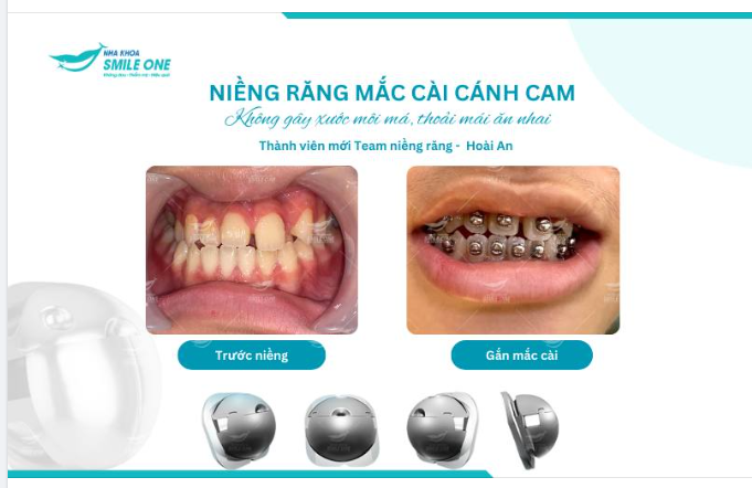 Mắc cài cánh cam - Không gây xước môi má, thoải mái ăn nhai!