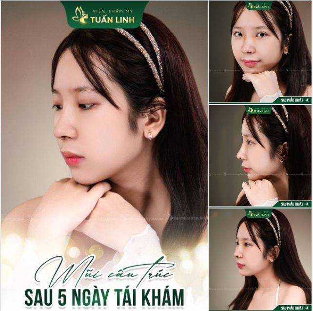 THAY DÁNG MŨI - ĐỔI DUNG NHAN - CÂN CHỈNH TỶ LỆ VÀNG - ĐẸP TINH TẾ!!