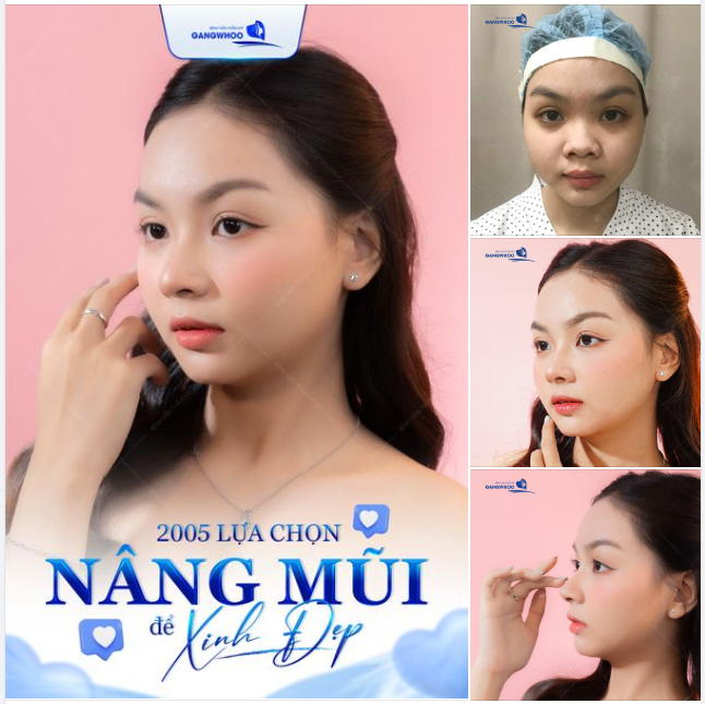 2005 LỰA CHỌN NÂNG MŨI CẤU TRÚC 3D