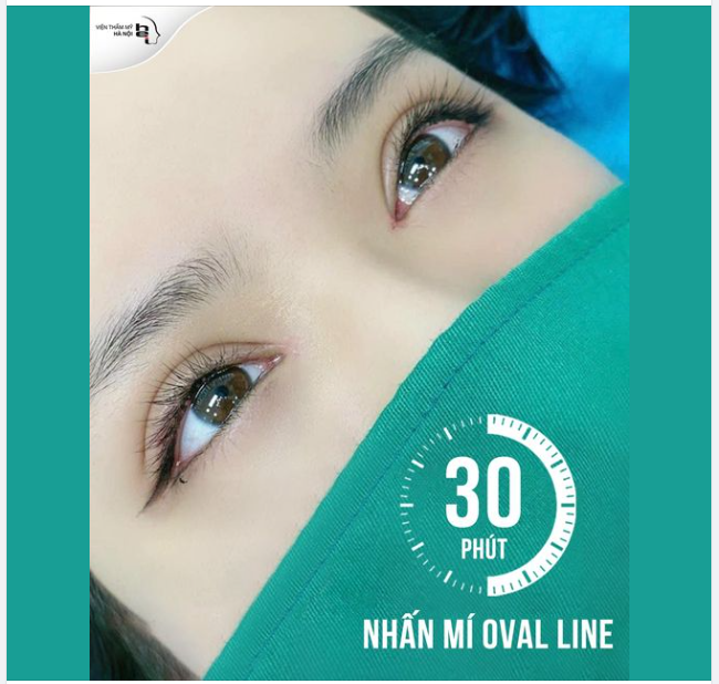 NHẤN MÍ OVAL LINE WIDE DEEP - ĐẸP NGAY SAU KHI LÀM!