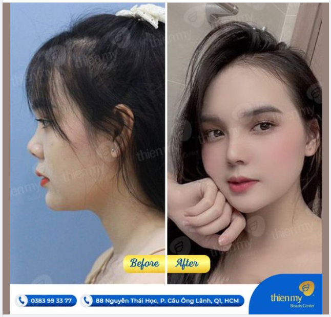 Hình ảnh thực tế sau khi nâng mũi tại PKCK Thiện Mỹ