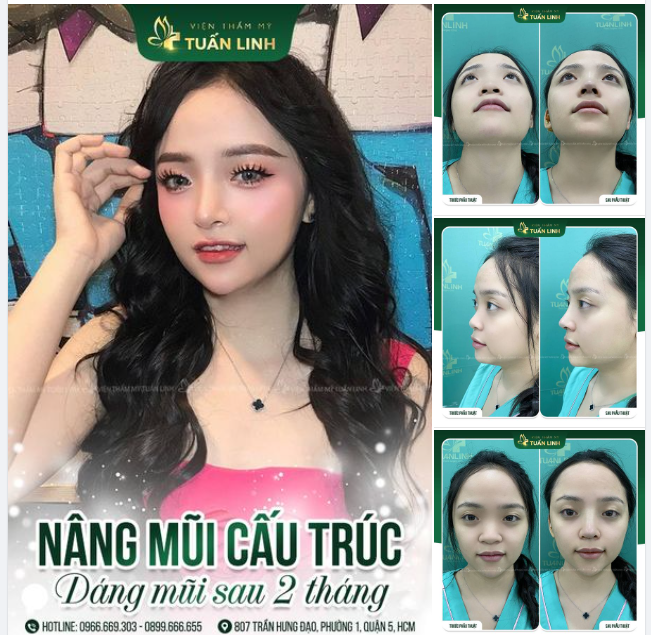 Bé khách siêu xinh đẹp sau 2 tháng nâng mũi tại Tuấn Linh.