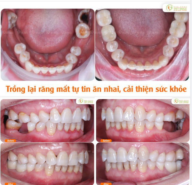 TRỒNG RĂNG IMPLANT SỰ LỰA CHỌN TUYỆT VỜI