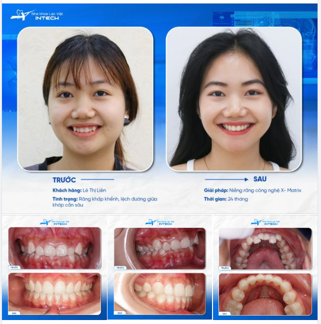 NIỀNG RĂNG X-MATRIX "LÃI" NGAY CẰM VLINE, MŨI CAO, HẾT HỞ LỢI!