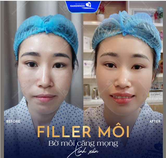 TIÊM FILLER MÔI Dáng môi siêu đẹp bờ môi căng mọng của khách hàng Gangwhoo