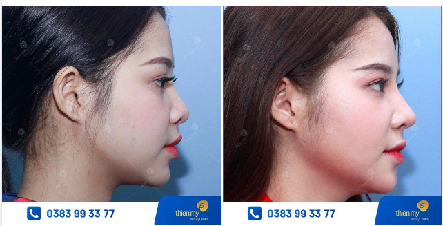 Dáng mũi tự nhiên, hài hoà khuôn mặt
