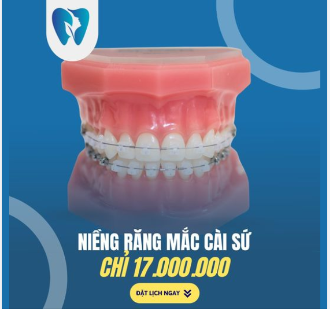 NIỀNG RĂNG MẮC CÀI SỨ - HIỆU QUẢ VÀ THẨM MỸ CAO