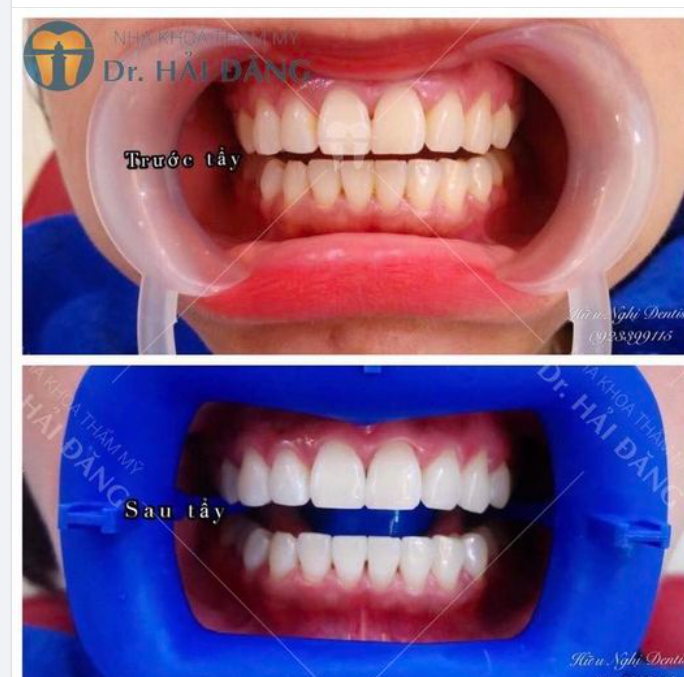 RĂNG TRẮNG SÁNG - NỤ CƯỜI ĐẸP SANG