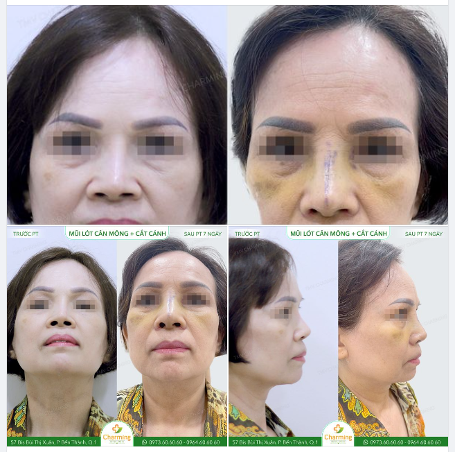 Cô khách của Charming đã từng thực hiện nâng mũi sau đó lại bị lệch sóng, phần chóp mũi da bị mỏng đi rất nhiều.