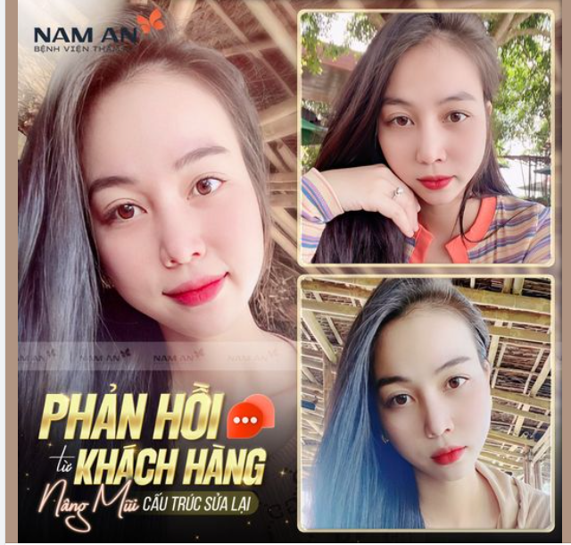 PHẢN HỒI TỪ KHÁCH HÀNG NÂNG MŨI CẤU TRÚC