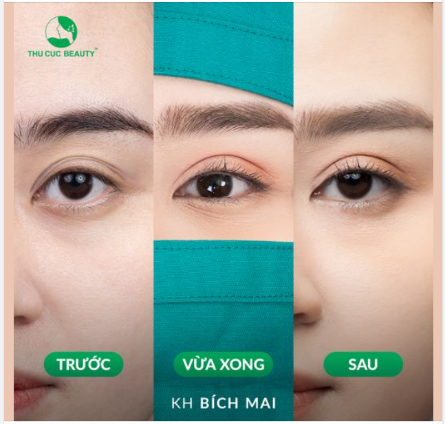 Sở hữu đôi mắt hai mí sắc nét không cần makeup nhờ cắt mí chỉ sau 15P