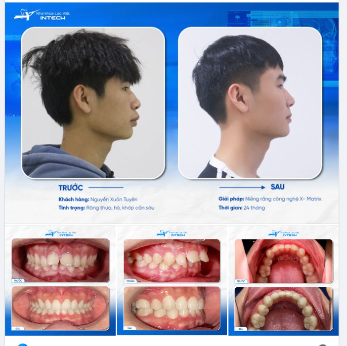 CÙNG CHIÊM NGƯỠNG GÓC NGHIÊNG “CỰC PHẨM” SAU 2 NĂM NIỀNG RĂNG X-MATRIX!