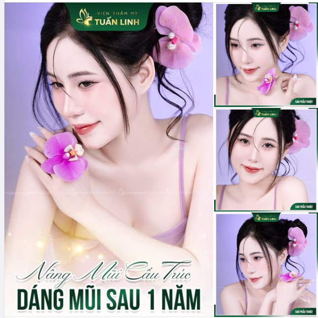 DÁNG MŨI SAU 1 NĂM - CHỈ 3 TỪ: ĐẸP XUẤT SẮC!!