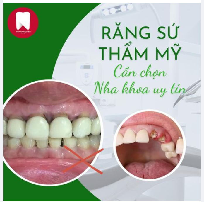 MẤT TIỀN MẤT CẢ RĂNG THẬT - ĐỪNG HỐI HẬN VÌ CHỌN SAI NHA KHOA