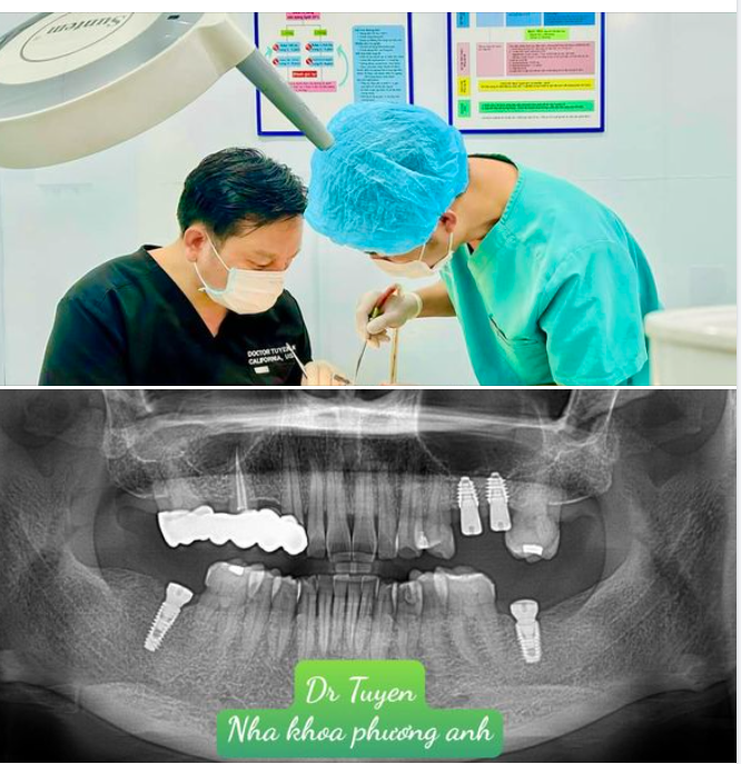 CHĂM SÓC RĂNG SAU KHI CẤY IMPLANT