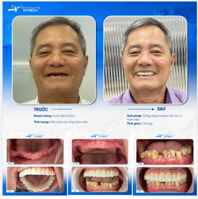 U70 "LÃO HÓA NGƯỢC" ẤN TƯỢNG CHỈ SAU 3 THÁNG TRỒNG RĂNG IMPLANT