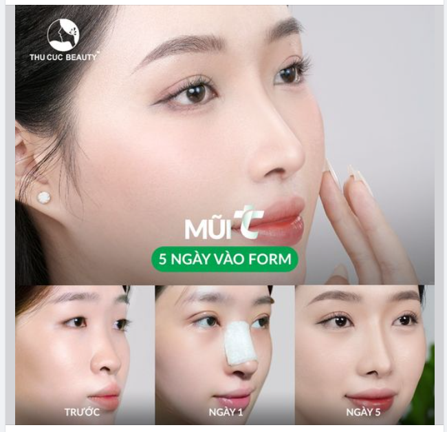 Thành quả sau 30P nâng mũi tại Thu Cúc