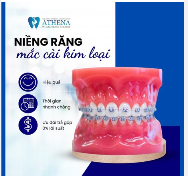 NIỀNG RĂNG MẮC CÀI  XÓA BỎ TỰ TI - NHẬN NỤ CƯỜI XINH