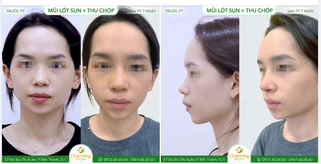 Phần dáng mũi ngắn, thấp và chóp mũi to khiến gương mặt nàng khách trông mất cân đối.