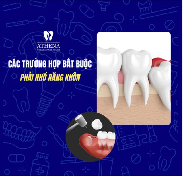 Bắt Buộc Nhổ Răng Nếu Gặp Phải Những Trường Hợp Này
