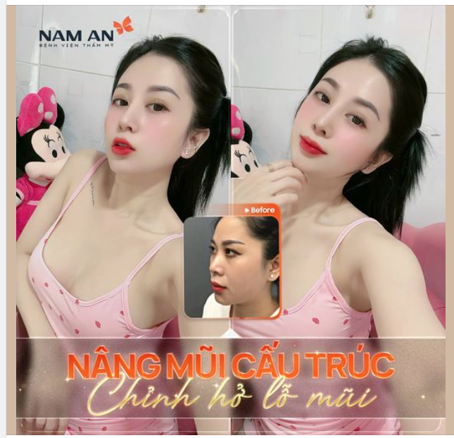 MŨI ĐẸP KHẮC PHỤC MỌI KHUYẾT ĐIỂM.