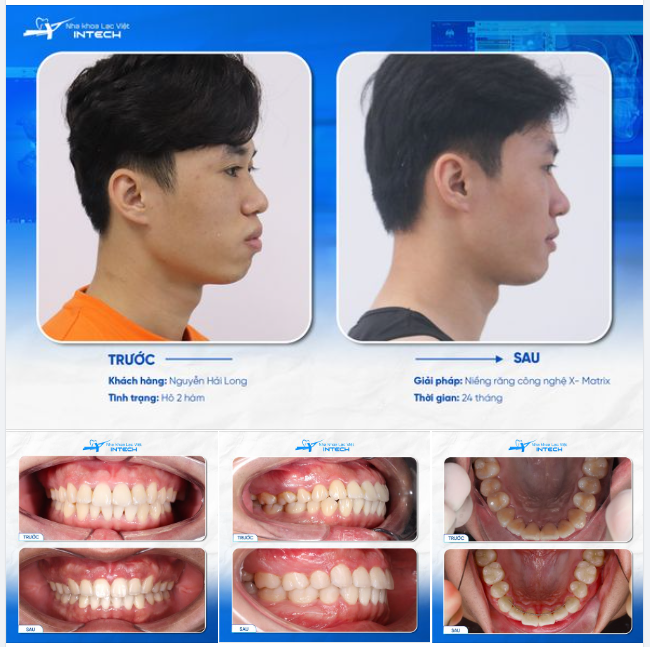 ĐƯỢC BIẾT TRƯỚC KẾT QUẢ BẰNG CÔNG NGHỆ X-MATRIX NHƯNG THÁO NIỀNG XONG VẪN NGỠ NGÀNG!