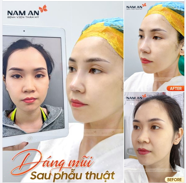 DÁNG MŨI SAU PHẪU THUẬT TẠI NAM AN