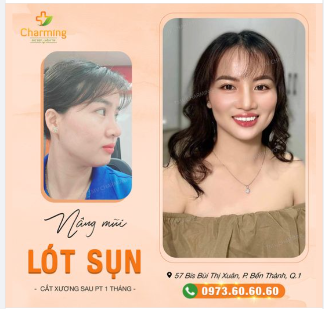 Nụ cười em vốn đã xinh. Lại thêm mũi đẹp nàng xinh hơn nhiều