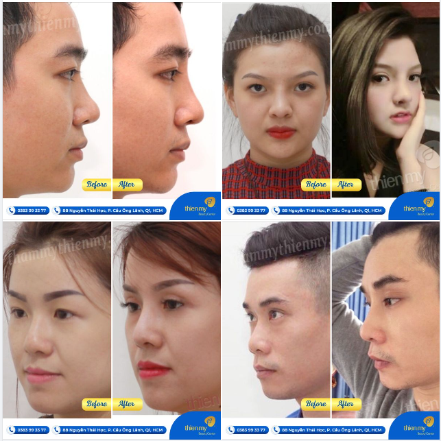 Đây là những hình ảnh đáng nhớ của khách hàng tại PKCK Thiện Mỹ, ghi lại những thay đổi sau khi nâng mũi.