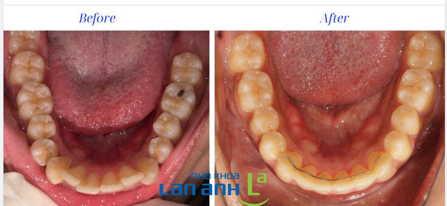 Niềng răng ở mức độ này có nên nhổ răng không?