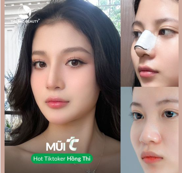 Thành quả sau 30P nâng mũi tại Thu Cúc