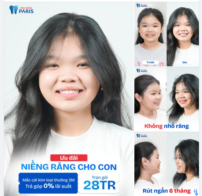 HOT ​​​​​​​NIỀNG RĂNG CHO CON - Không đau - Hạn chế nhổ răng