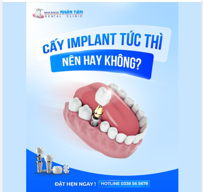 Cấy Implant tức thì. Nên hay không?